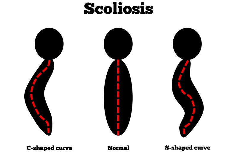 Alpharetta, GA scoliosis treatment